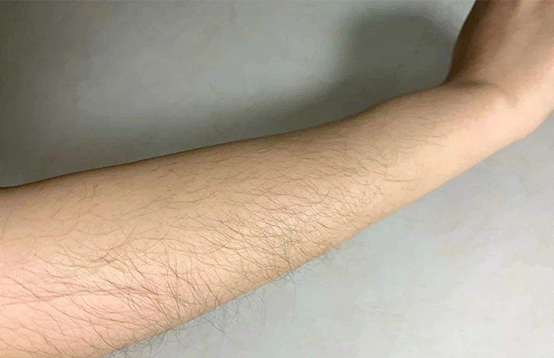 如何选择一款有效的脱毛仪
