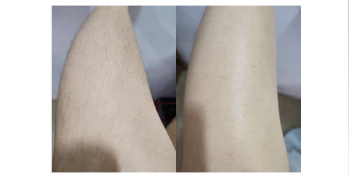 如何摆脱体毛浓密的困扰？体毛浓密女孩过来看看(图2)