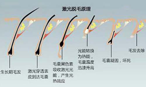 夏季脱毛：为什么有人说光子脱毛没有效果？(图2)