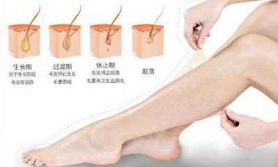 夏季脱毛：为什么有人说光子脱毛没有效果？