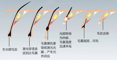 为什么有时候感觉家用脱毛仪效果不明显？(图2)