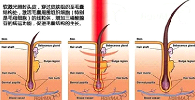 永久脱毛有哪些方式和对比效果(图1)