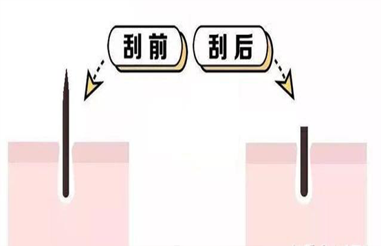 脱毛不彻底，毛毛的生命力到底有多顽强？(图3)